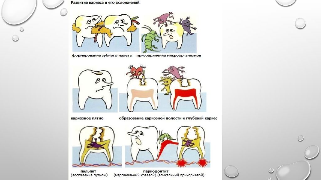 Стадии кариеса картинки