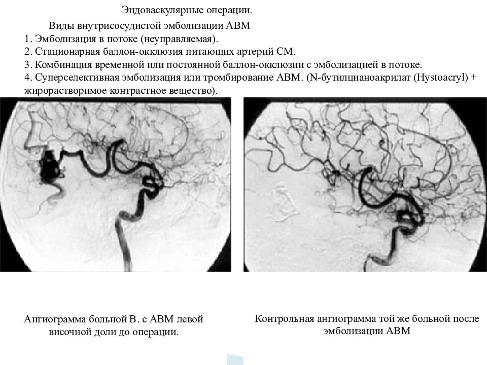 Аневризма головного мозга эндоваскулярным. Эндоваскулярная эмболизация АВМ головного мозга. Мальформация височной артерии. Эндоваскулярная эмболизация аневризм сосудов головного мозга.. Эмболизация АВМ сосудов головного мозга.