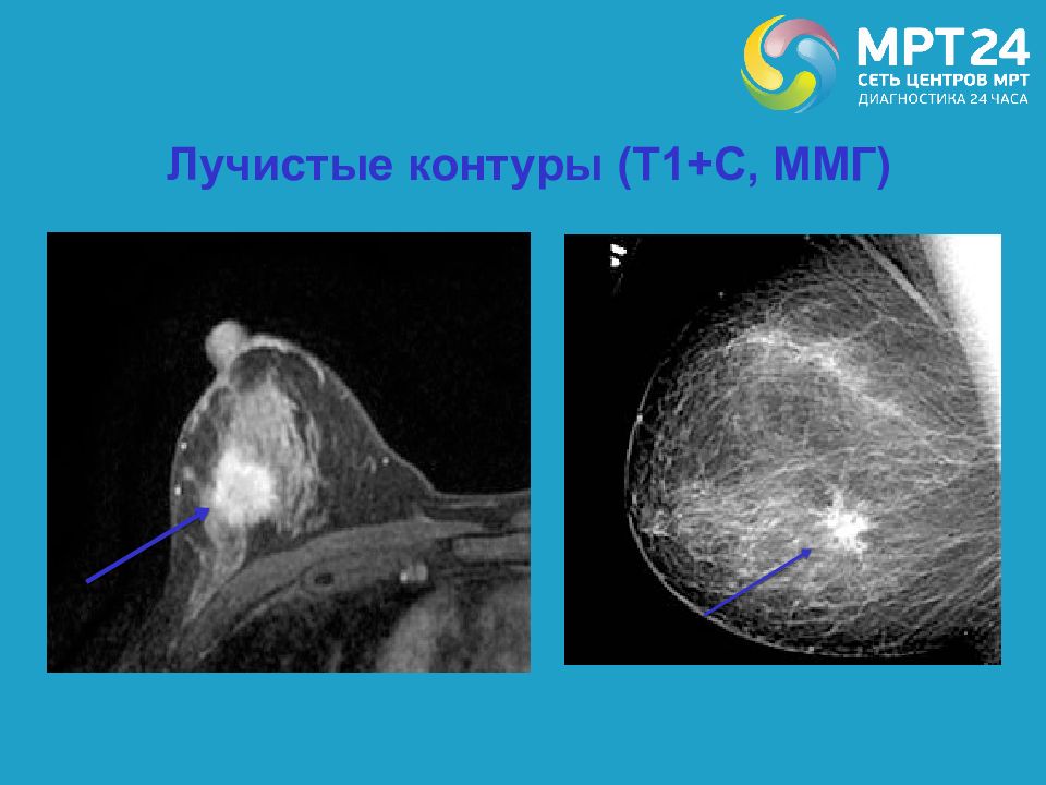 Нечеткие контуры. Новообразования в молочной железе с нечеткими контурами. Узловое образование молочной железы с лучистыми контурами. Образование с лучистыми контурами на маммографии. Опухоль с лучистыми контурами молочной железы.