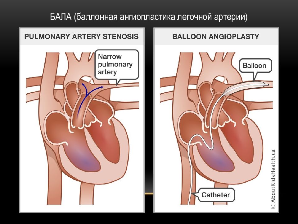 Легочная гипертензия картинки