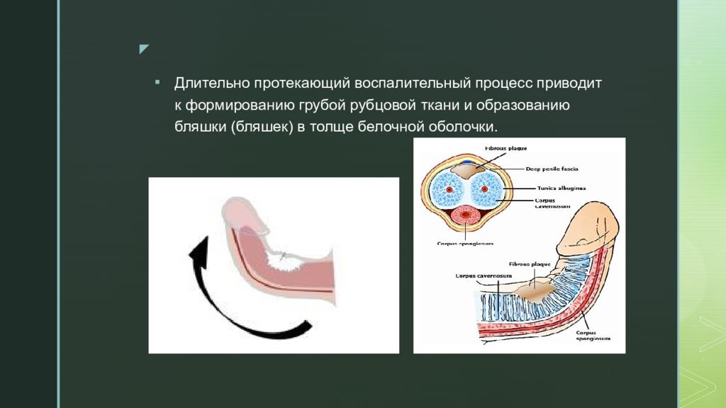 Кривой Пенис