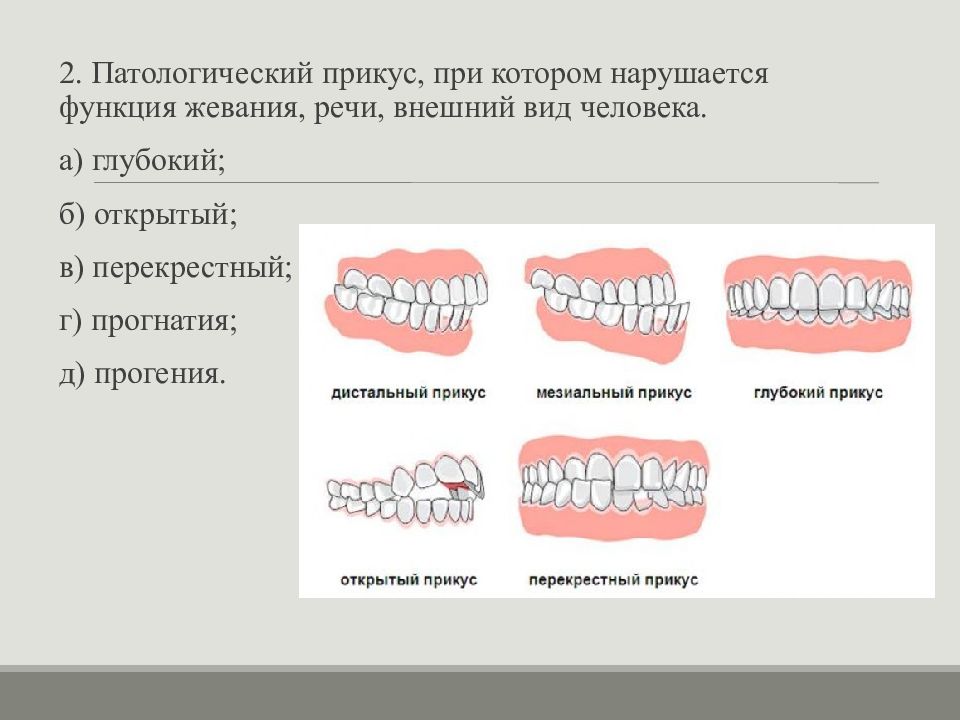 Виды прикуса. Дистальный перекрестный прикус. Прогнатия прогения открытый прикус. Глубокий перекрестный прикус. Дистальный прикус прогнатия.