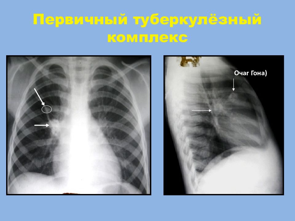Первичный туберкулез картинки