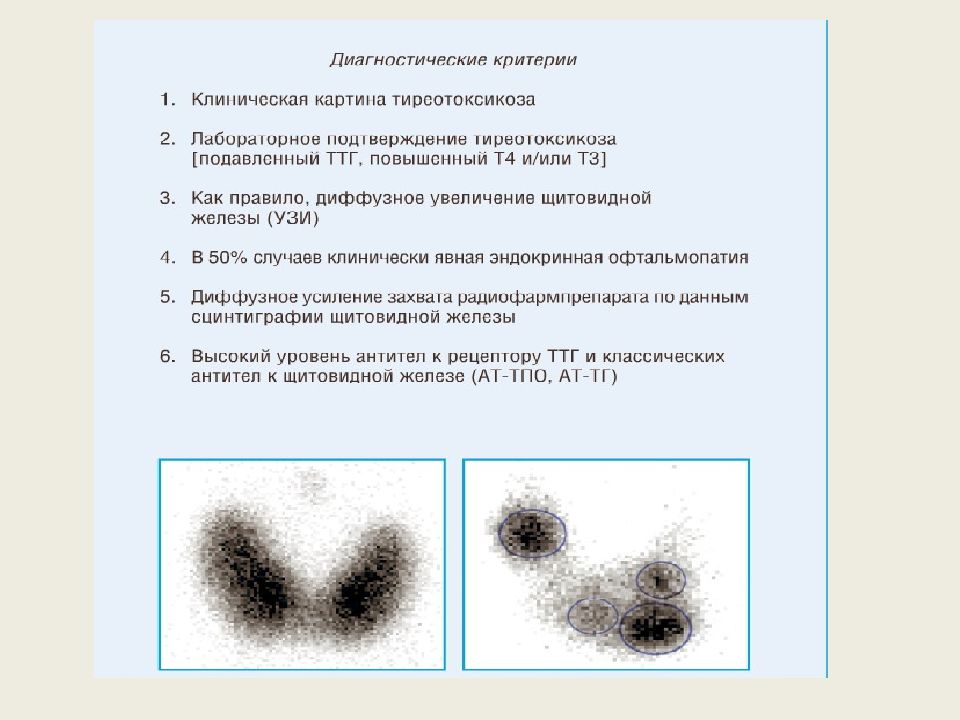 Диффузный токсический зоб ( болезнь Грейвса, Базедова болезнь, ДТЗ ...