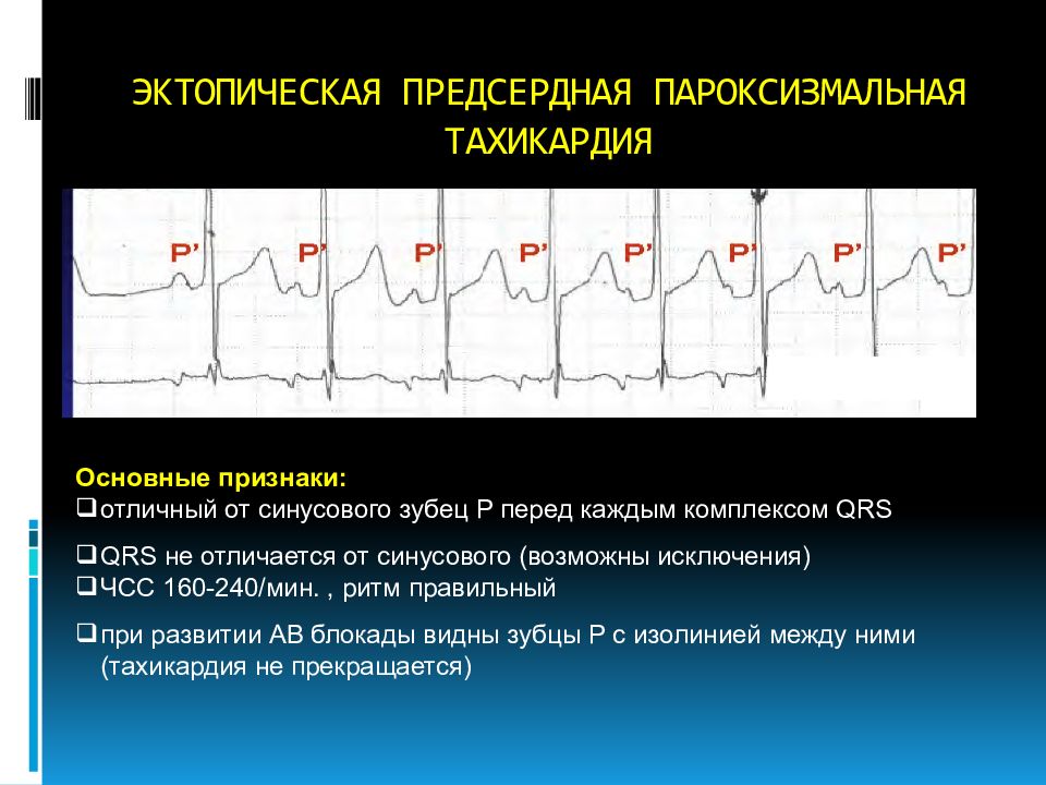 Предсердная тахикардия. Предсердная тахикардия на ЭКГ признаки. Фокусная предсердная тахикардия ЭКГ. Эктопическая тахикардия ЭКГ. Предсердная пароксизмальная тахикардия на ЭКГ признаки.