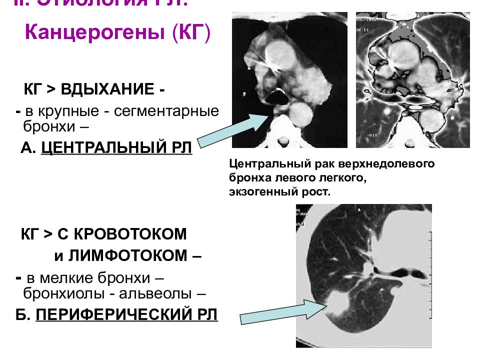 Рак центрального правого. Онкология левого легкого. Фото раковой опухоли 2в стадии центрального бронха.