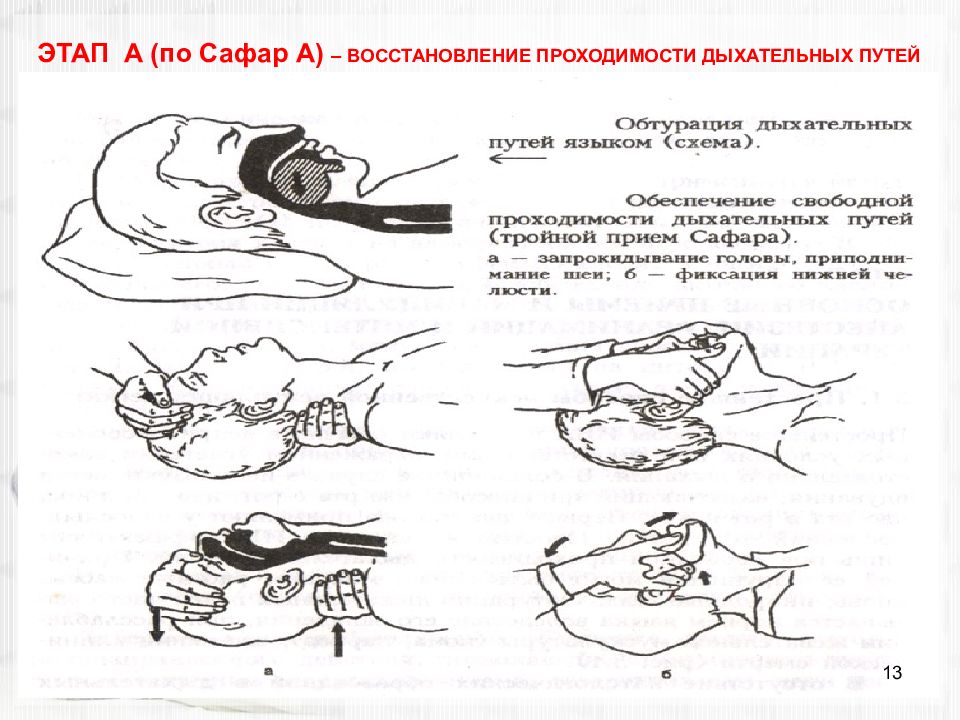 Последовательность действий по восстановлению дыхательных путей. Приемы восстановления проходимости верхних дыхательных путей. Тройной прием Сафара алгоритм. Обеспечение свободной проходимости дыхательных путей алгоритм. Тройной прием для обеспечения проходимости дыхательных путей.