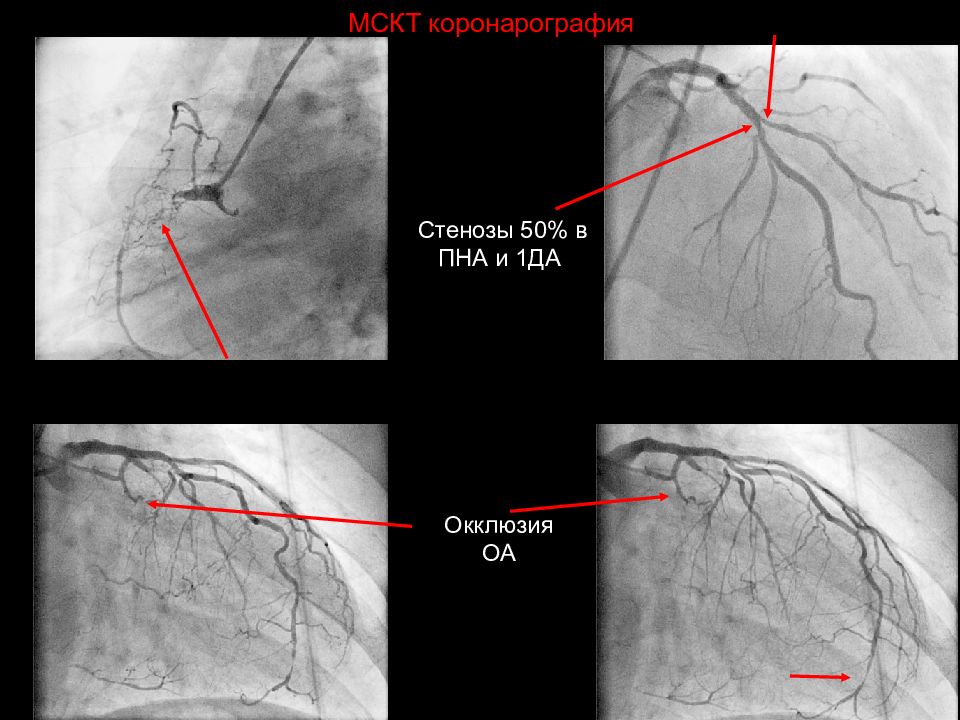 Пна. Коронарография стеноз. Окклюзия коронарной артерии на коронарографии. Правая коронарная артерия стеноз 90%. Коронароангиография стеноз.