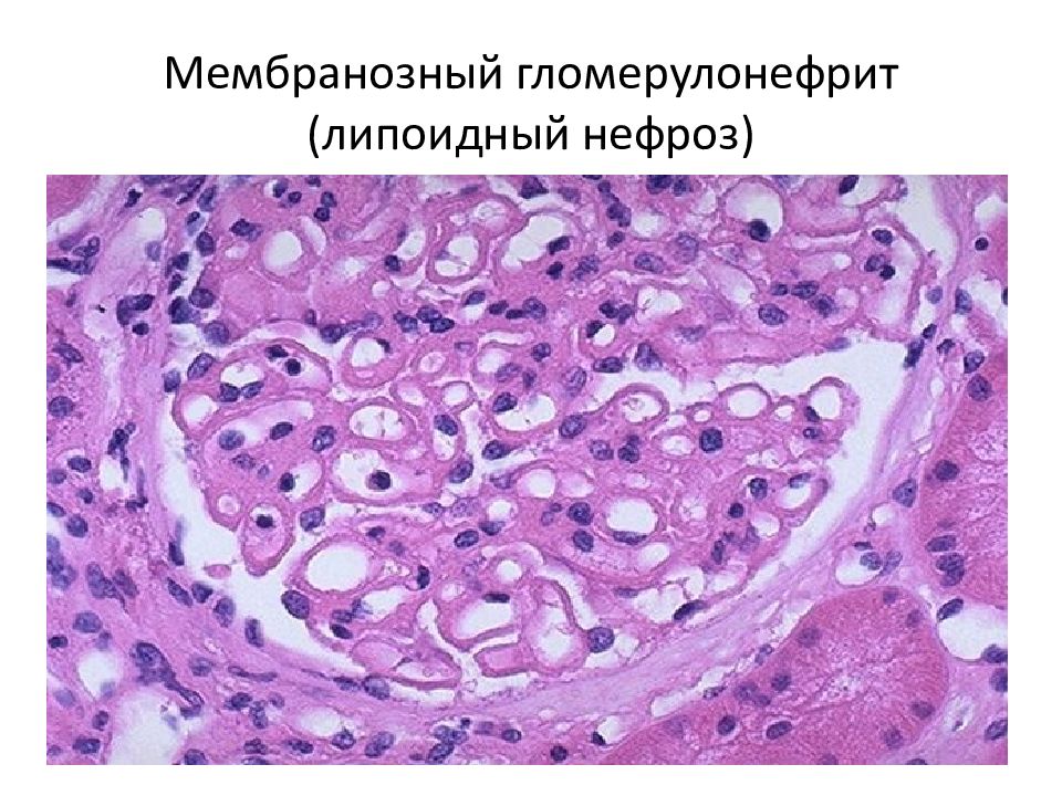 Нефроз