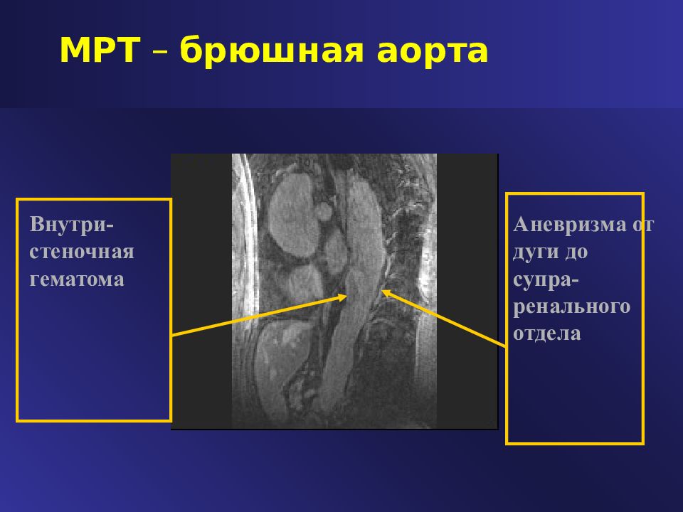 Аневризма брюшной полости. Атеросклероз брюшной аорты рентген. Атеросклероз аорты аневризма аорты. Мрт брюшного отдела аорты. Атеросклероз брюшного отдела аорты.