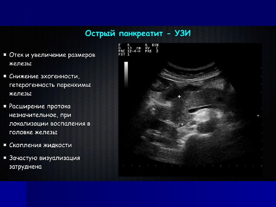 Узи картина хронического панкреатита