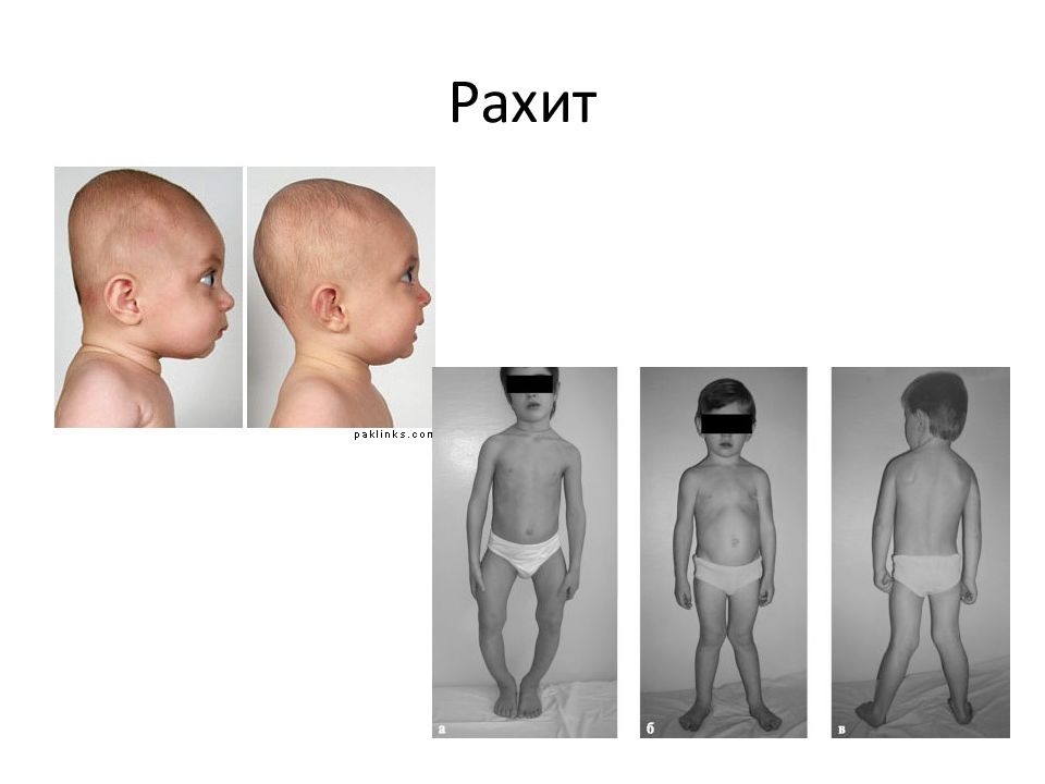 Рахит балаларда презентация