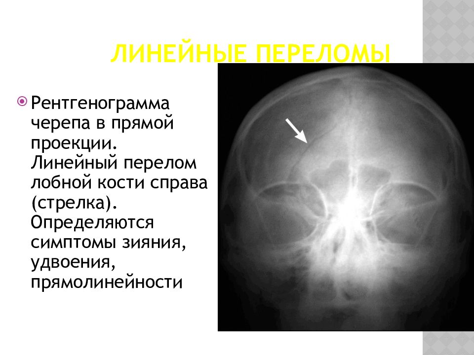 Импрессионный перелом