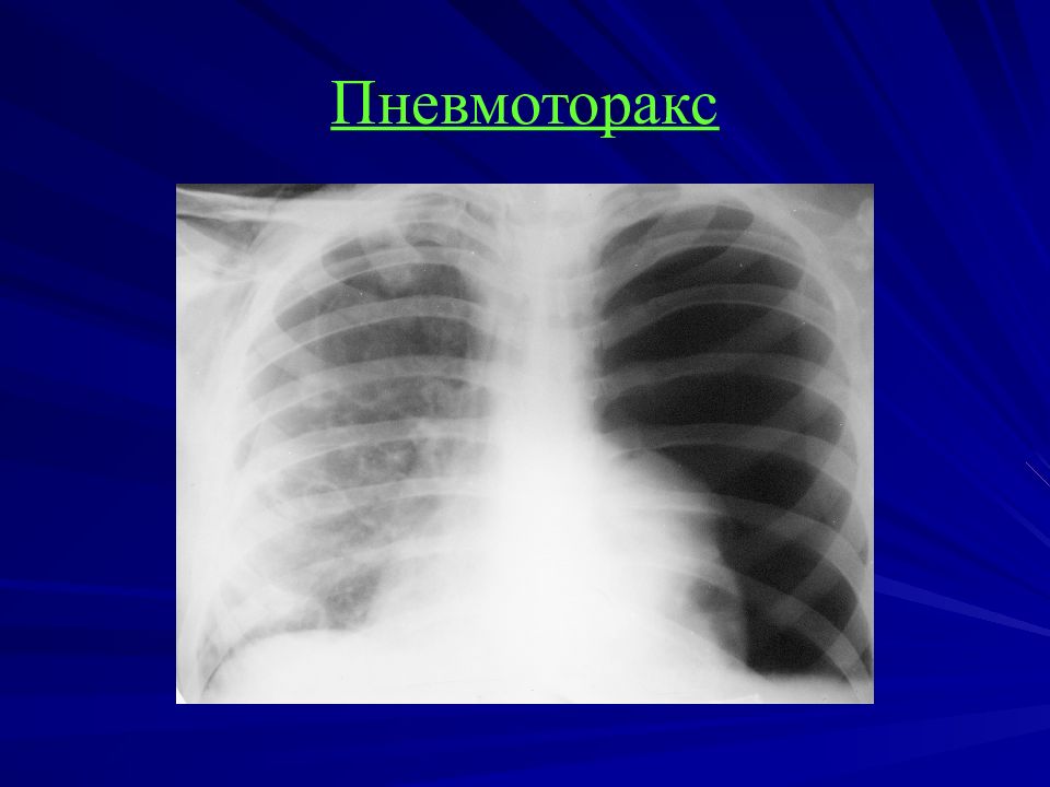 Коллапс легкого это. Рентгенография грудной клетки пневмоторакс. Спонтанный пневмоторакс рентген картина. Правосторонний пневмоторакс рентген. Рентгенодиагностика пневмоторакса.