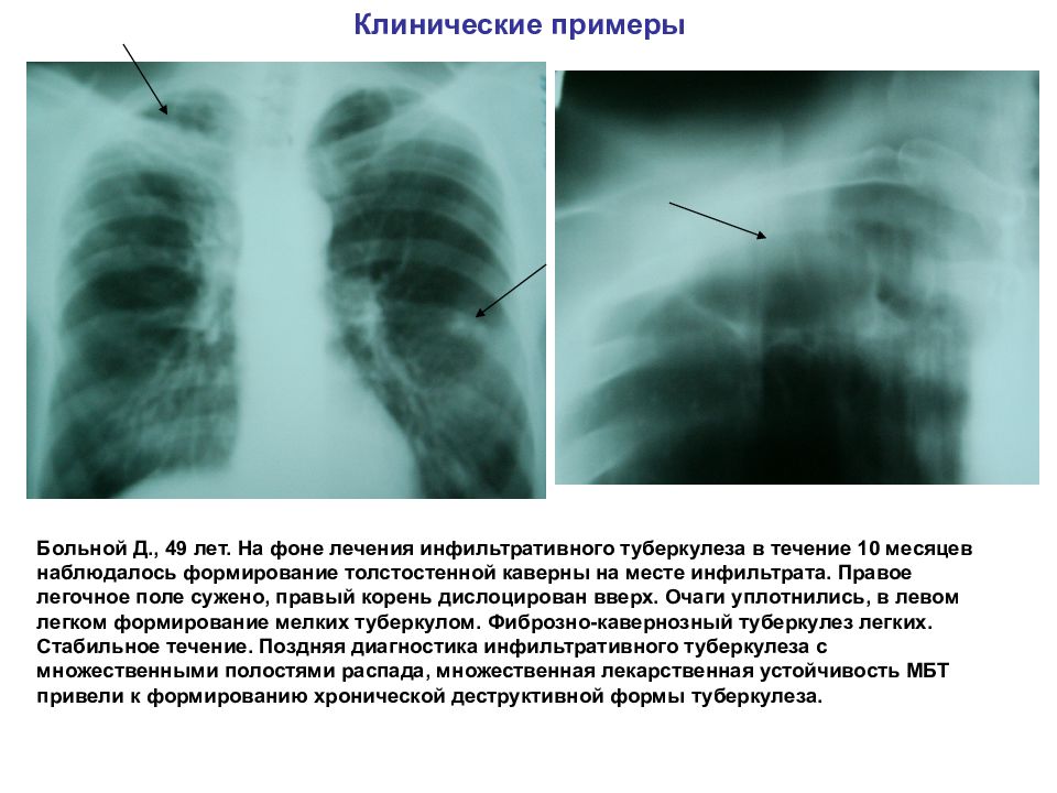 Очаговый и инфильтративный туберкулез презентация