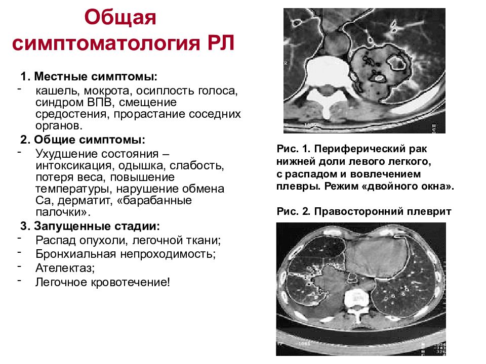 Рак легкого диагностика презентация