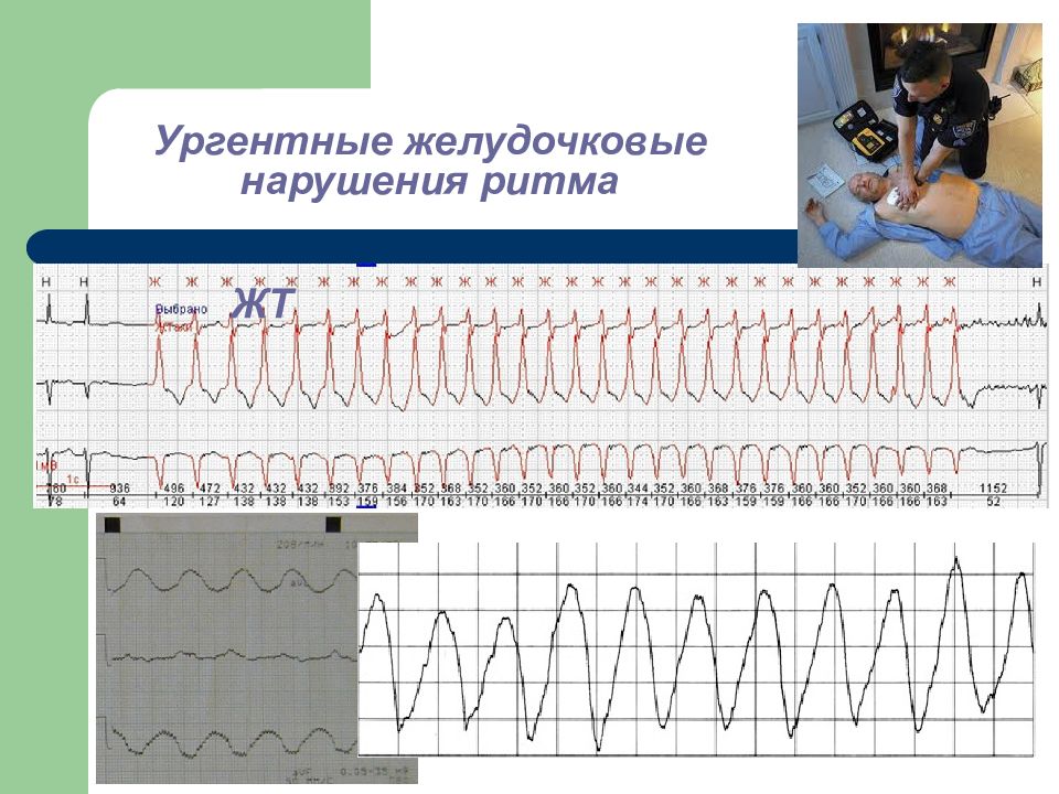 Желудочковая тахикардия лечение. Желудочковые нарушения ритма. Ургентные нарушения ритма. Злокачественные желудочковые нарушения ритма. Желудочковые нарушения ритма презентация.