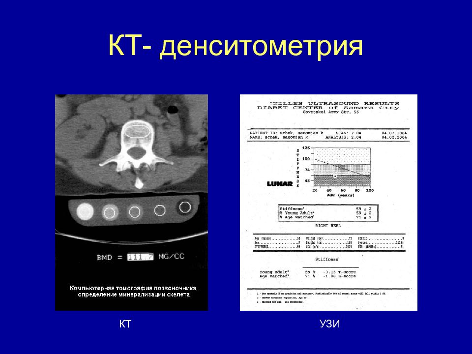 Денситометрия костей. УЗИ плотности костной ткани. Рентген денситометрия расшифровка. Кт денситометрия позвоночника. Измерение минеральной плотности кости (денситометрия) показано при.