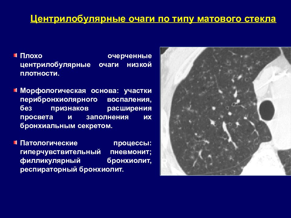 Кт картина бронхиолита