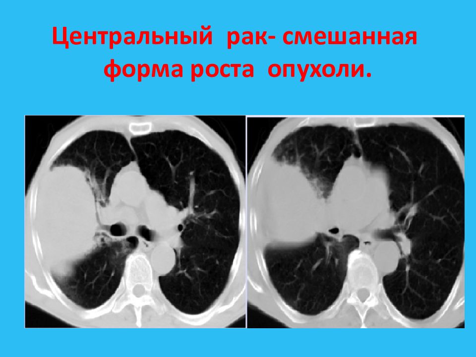Рак центрального правого. Центральная опухоль легкого. Центральная карцинома легкого. Центральный тумор левого легкого. Смешаннле форма поста опухоли легких.