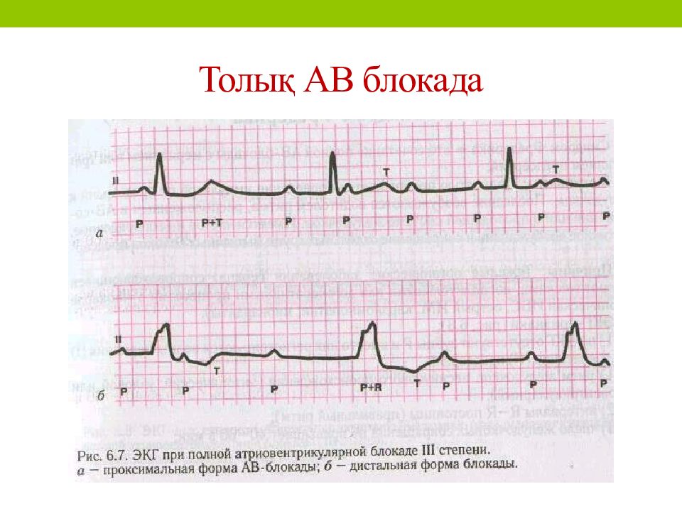 Ав блокада презентация