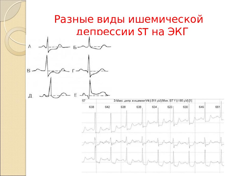 Депрессия st. Депрессия St на ЭКГ при ишемии. Избыток магния на ЭКГ. При каких заболеваниях на ЭКГ наблюдается депрессия St.