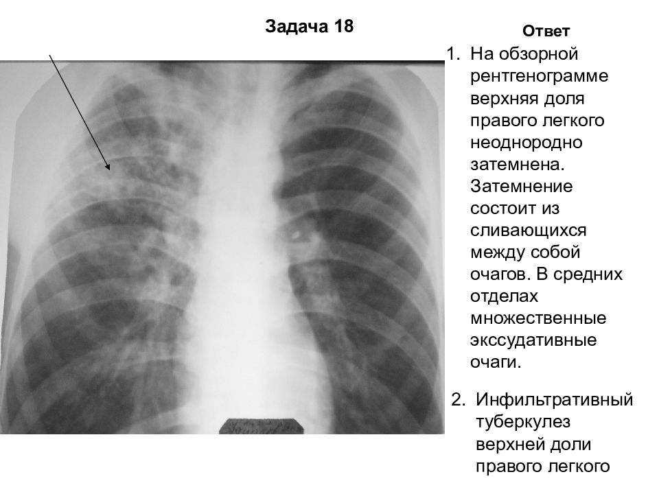 Рентген легких при туберкулезе фото с описанием