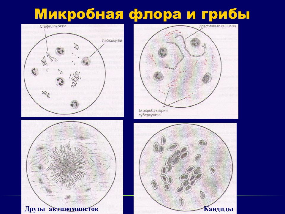 Грибы в мокроте