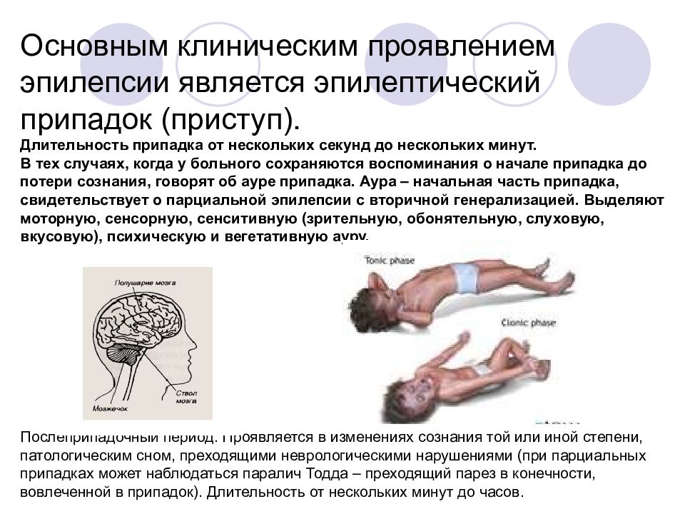 Приступ это. Судорожный приступ эпилепсии. Эпилептический припадок клинические симптомы. Судороги при эпилепсии у детей описание. Эпилепсия судорожные пароксизмы.