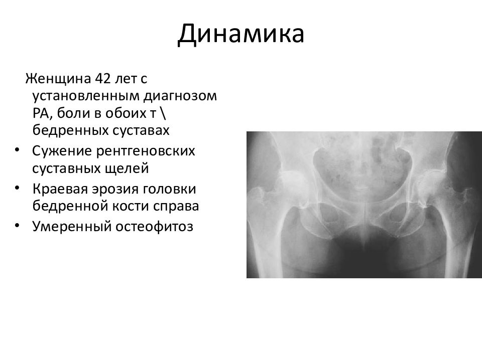 Бедренная щель. Суставная щель тазобедренного сустава. Боль в головке бедренной кости. Артрит головки бедренной кости. Сужение суставной щели.