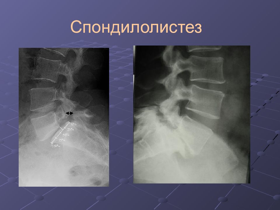 Лучевая диагностика позвоночник презентация