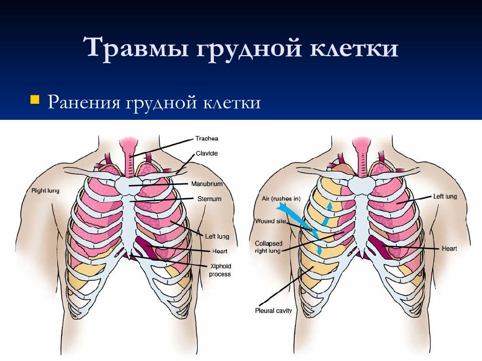 Травма груди. Непроникающая травма грудной клетки. Ранение грудной клетки. Травмы органов грудной клетки.