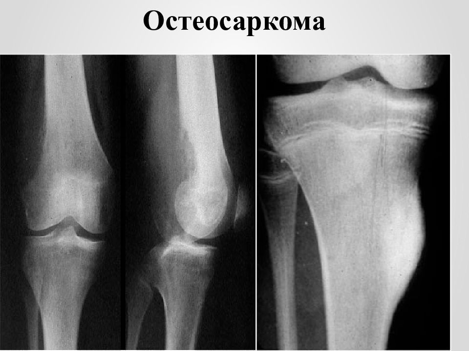 Остеосаркома. Остеосаркома большеберцовой кости рентген. Параоссальная остеосаркома. Остеосаркома стопы рентген. Телеангиэктатическая остеосаркома.