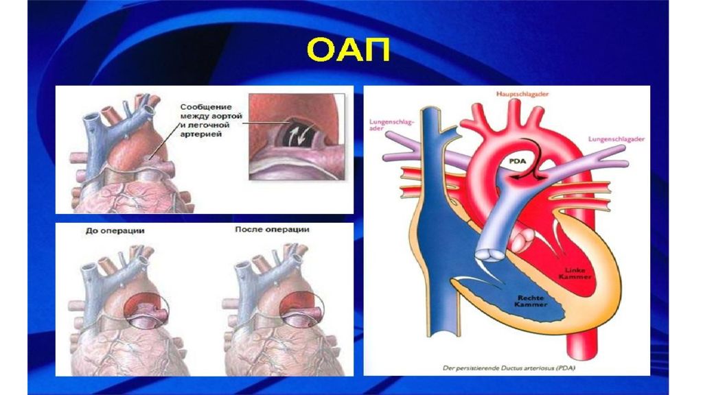 Артериальный проток у новорожденных. Открытый артериальный проток синдромы. Боталлов проток операция. Открытый артериальный (боталлов) проток операция.