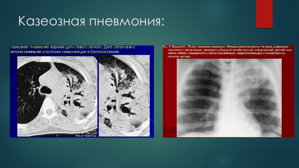 Казеозная пневмония фтизиатрия презентация