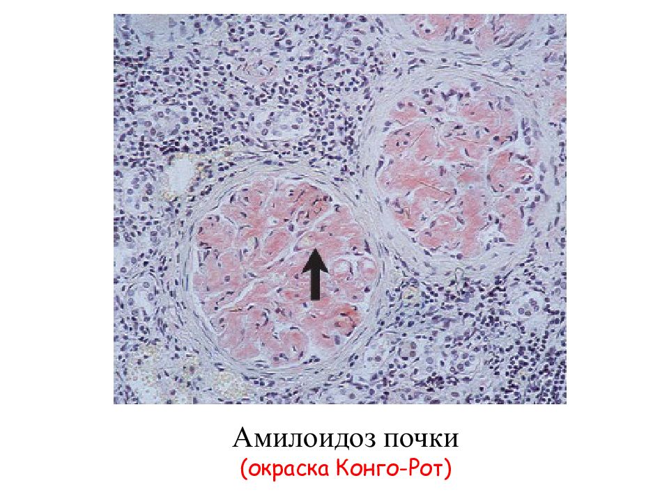 Амилоидоз почки рисунок