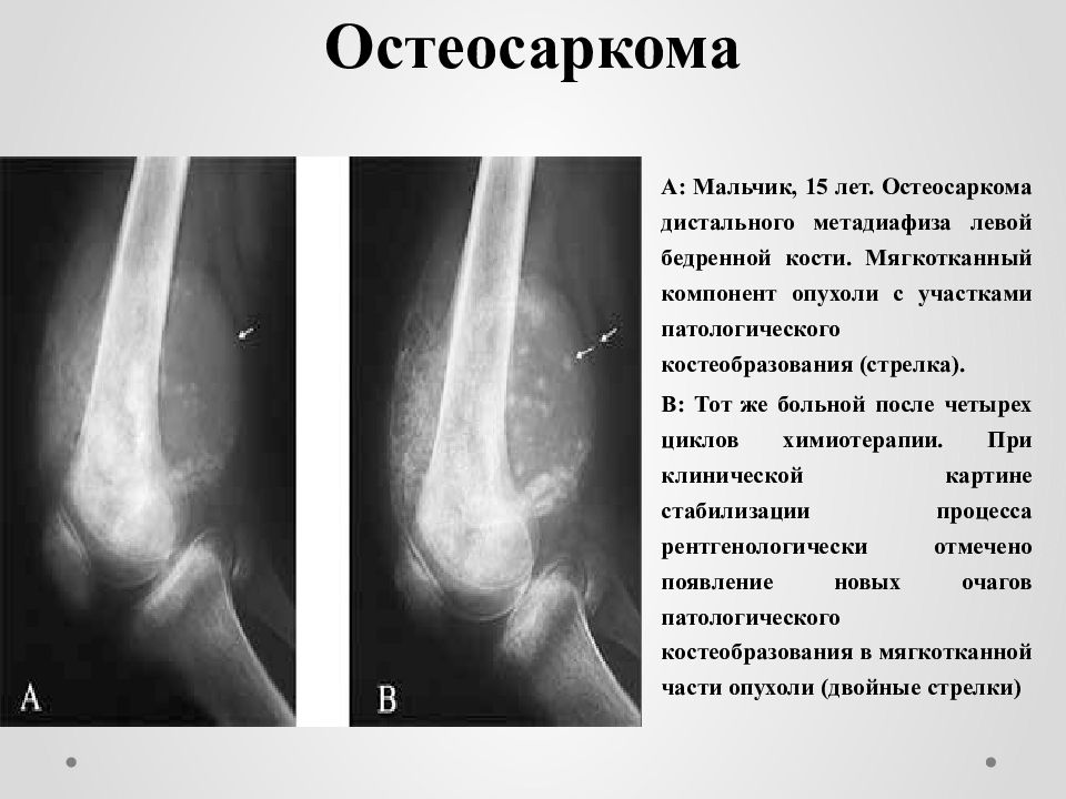 Клиническая картина при остеогенной саркоме в начале заболевания выражается следующими признаками