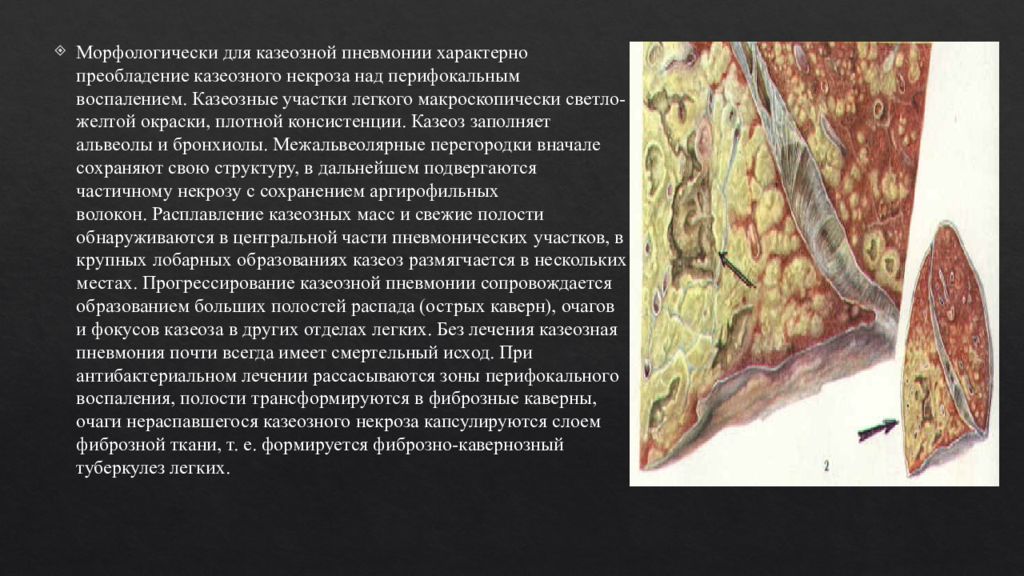 Казеоз это. Казеозная пневмония макропрепарат. Казеозную пневмонию препарат патанатомия. Казеозная пневмония патанатомия. Казеозная пневмония патологическая анатомия.