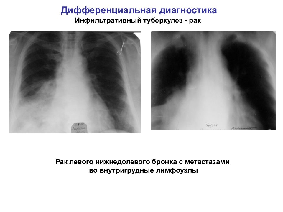 Туберкулез легких клиническая картина