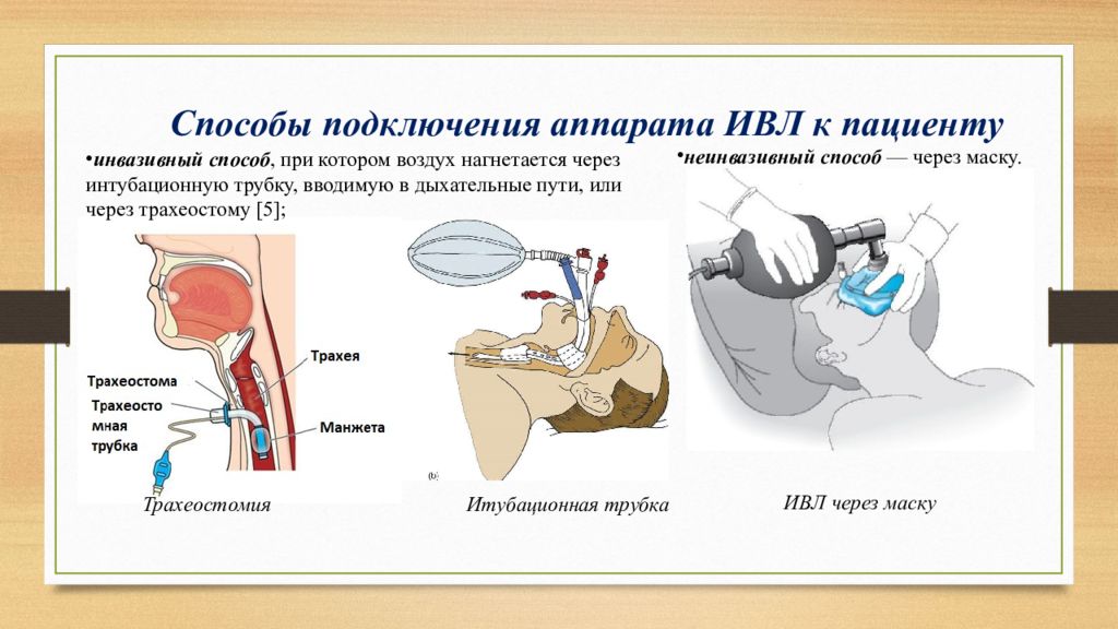 Почему после воздухом. ИВЛ аппарат как подключают. Принцип действия ИВЛ. Как подсоединяют аппарат ИВЛ. Аппарат искусственной вентиляции легких с трубкой.