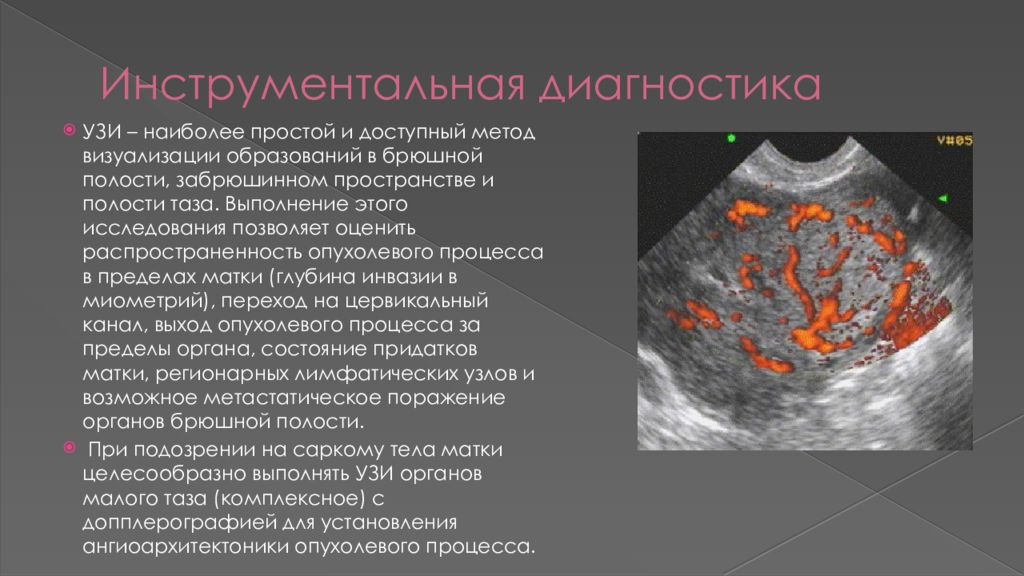 Рак матки саркома. Саркома матки классификация.