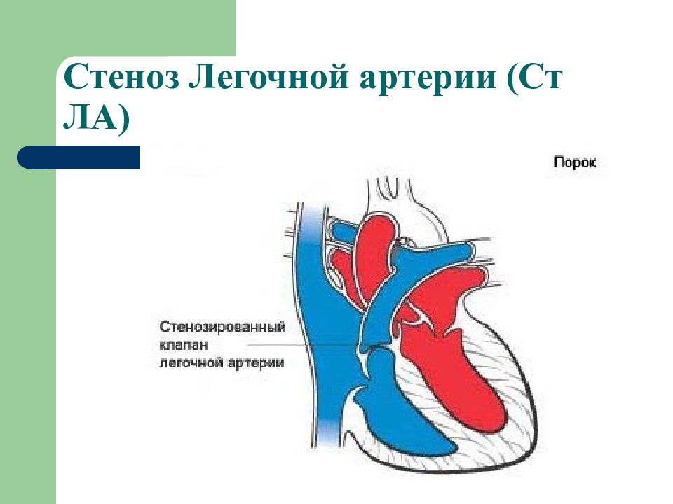 Клапан легочной артерии. Стеноз клапана легочной артерии гемодинамика. Надклапанный стеноз легочной артерии у ребенка. Пороки сердца изолированный стеноз легочной артерии. Изолированный стеноз легочной артерии у детей гемодинамика.