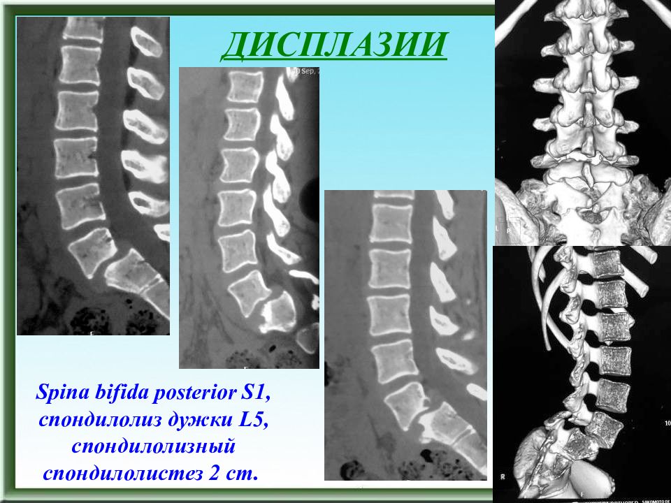 Spina. Спондилолиз l5. Дисплазия l5 позвонка.