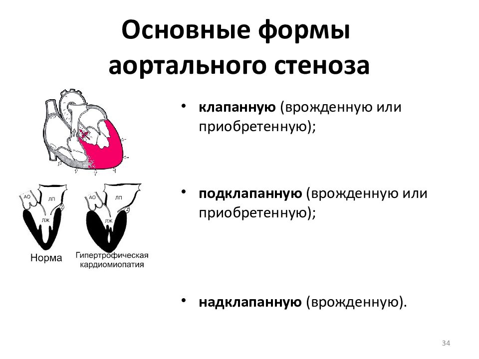 Пороки аортального клапана презентация