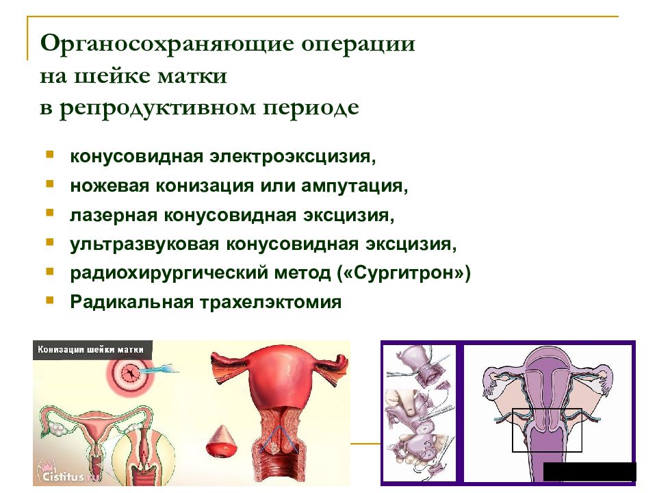 Эксцизия шейки матки. Конусообразная ампутация шейки матки. Конусовидная электроэксцизия шейки матки. Петлевая электроэксцизия шейки матки. Ножевая ампутация шейки матки.