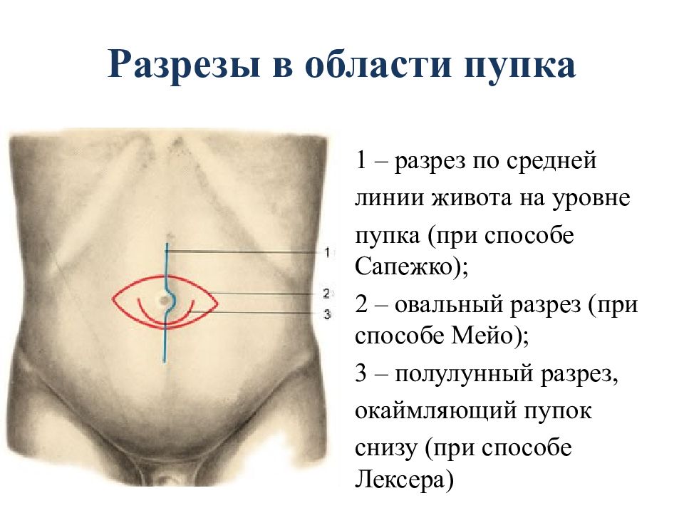 Области передней брюшной стенки схема