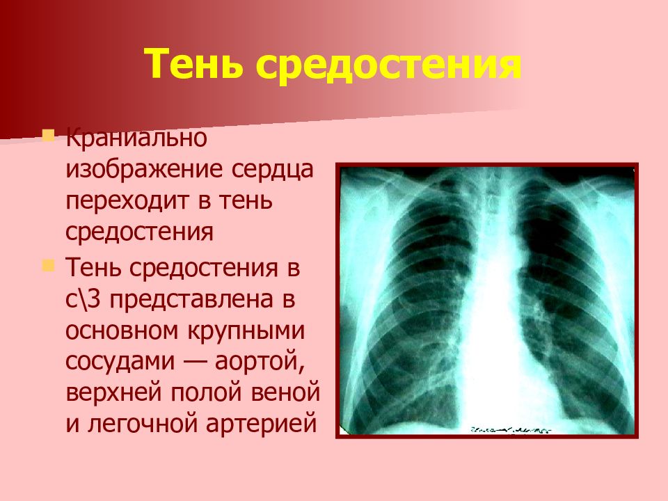 Тень сердца расширена. Средостение на рентгенограмме в норме. Тень средостения. Тень средостения рентген. Тень средостения расширена.