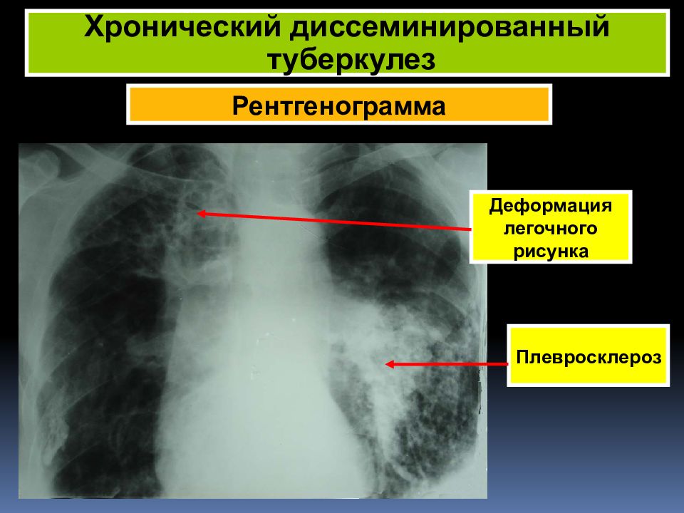 Деформация легочного рисунка по ячеистому типу