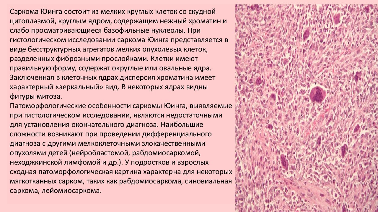 Саркома юинга презентация