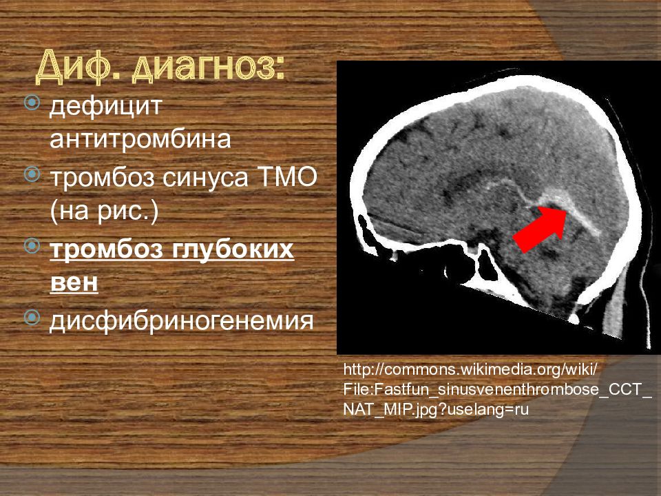 Тромбоз дифференциальная диагностика